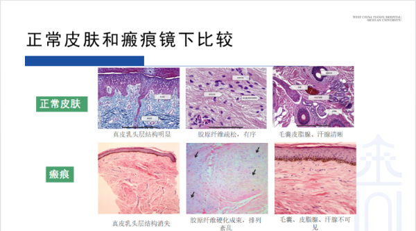 策略吧 读懂瘢痕——修复我们皮肤上的“地质图”